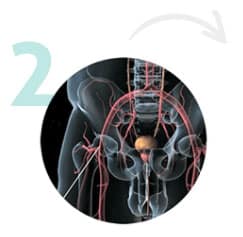 embolização da próstata